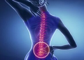 Manifestazioni di osteocondosi lombare